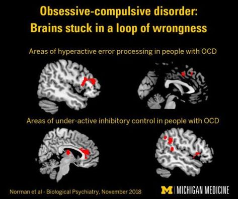 Cbt For Ocd, Ocd Brain, Brain Scans, Brain Models, Brain Images, Dna Testing, Brain Scan, Psychology Disorders, Brain Surgery