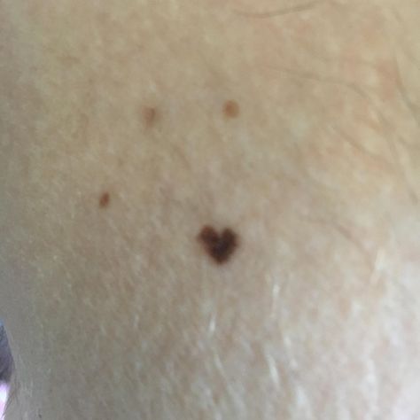 Heart Shape Mole, Heart Shaped Mole, Heart Mole, Back Moles, Tattoo Mole, Specific Features Shifting, Tattoo Claims For Dr, Heart Shaped Birthmark, Specific Features Claim