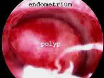 Hysteroscopy Endometrial Polyps, Uterine Polyps, Fertility Clinic, Ivf Clinic, Fertility, Baby Stuff, India, Health