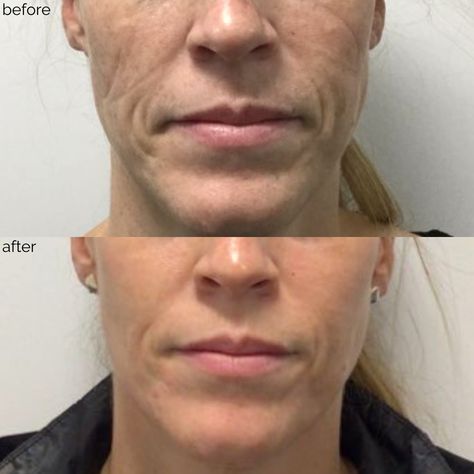 Ipl Before And After, Ipl Laser Before And After, Ipl Photofacial Before And After, Facial Before And After, Laser Facial, Laser Skin Resurfacing, Laser Resurfacing, Intense Pulsed Light, Laser Surgery