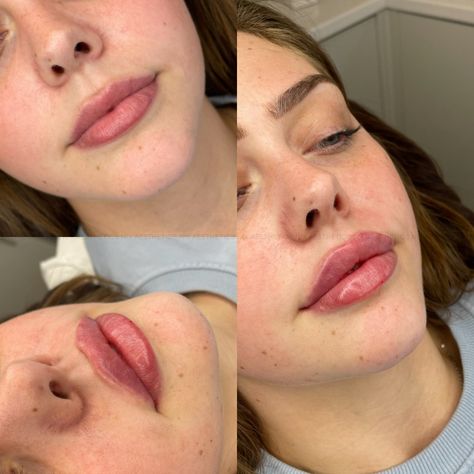 Lip Filler Russian Technique, Russian Lips Filler, Filled Lips, Desired Lips, Aesthetic Practitioner, Russian Lips, Hyaluronic Acid Lips, Swansea Wales, Lip Combos