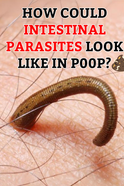 Intestinal parasites might appear as small white specks, thread-like structures, or dark, tarry material in stool. #ParasiteAwareness #GutHealth #HealthTips Parasites In Humans, Intestinal Parasites, Stomach Cramps, Bile Duct, Health Ideas, Consumer Protection, Eating Raw, Natural Medicine, Health Products