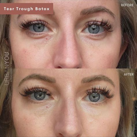 Tear Trough Botox | Before and After Botox Under Eyes, Botox Results, Skin Tightening Procedures, Forehead Lines, Under Eye Fillers, Botox Before And After, Face Fillers, Frown Lines, Tear Trough