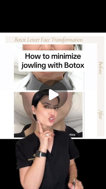 Lone Tree Aesthetics by Enki | Colorado RN Aesthetic Injector on Instagram: "minimizing jowling with Botox. It can be done by treating the DAO, the mentalis muscle, the platysmal bands and some injections on the jawline. Please be aware the number of Botox units required for each patient varies greatly on how large your muscle is, how strong it is, the position of your muscle, and other factors. #botox #dao #jowling #jowls #lowerface #sharpjawline #nurseinjector #beforeandafter #results #denver #colorado #lonetree" Dao Botox Injection Before And After, Platysmal Band Botox Before And After, Botox For Jawline, Dao Muscle Botox Before And After, Dao Botox Before After, Dysport Injection Sites, Botox For Jowls, Jaw Botox Before After, Where To Get Botox On Face