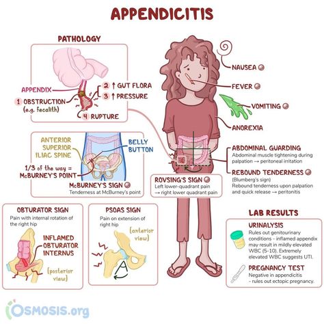 Osmosis on Instagram: “What are the most relevant differential diagnoses for appendicitis? Share your answers below. ⬇️ . Appendicitis is when the appendix gets…” Med Surg Gi Disorders, Pediatric Gi Disorders Nursing, Decelerations Nursing, Osmosis Nursing, Emt Worksheets, Advanced Emt, Emt Basic, Nursing Procedures, Hospital Medicine