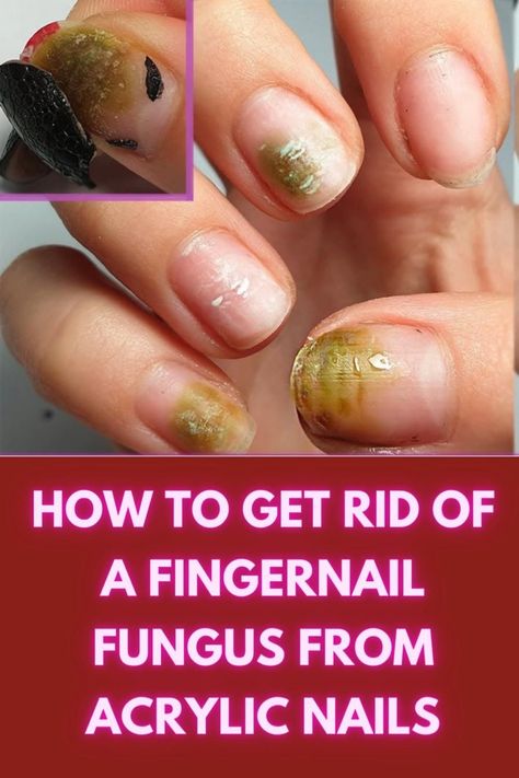 Fungal Nail Fingernail Fungus Remedies, Nail Ideas Gel, Ugly Toenails, Aloe Vera For Sunburn, Fingernail Fungus, Remove Acrylic Nails, Nail Problems, Fungal Nail, Dry Skin Remedies