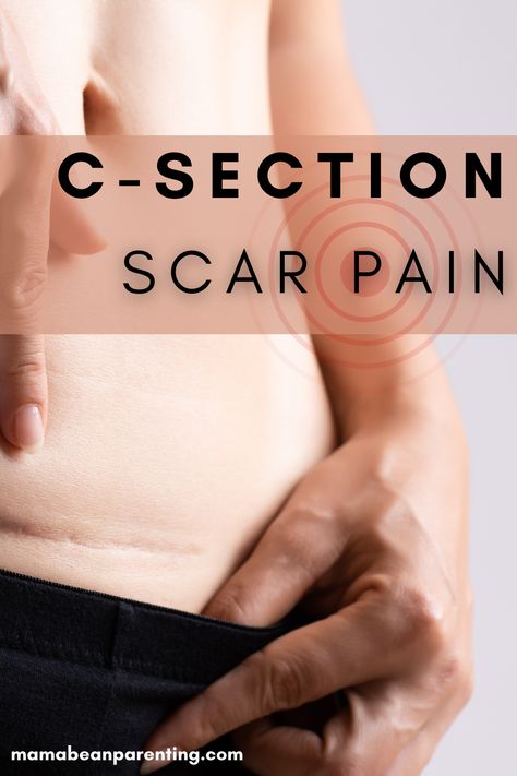 If you’re having problems with C-section scar pain, this article will help you. As always, you should go and see a doctor if you’re in a lot of pain or if there is something leaking from the scar. Unfortunately, sometimes the doctors can’t help. Sometimes, everything is perfectly fine, but your C-section scar still hurts. C Section Scar, C Section Scars, C Section, Pregnancy Birth, Always You, A Doctor, Chronic Pain, Things To Think About