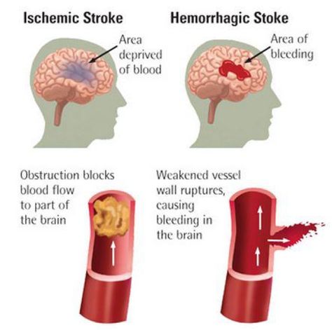 The types of stroke - ischaemic and haemorrhagic Emt Study, Nursing School Survival, Nurse Rock, Nursing School Tips, Nursing School Notes, Nursing Tips, Future Nurse, Nursing Study, Nursing Notes