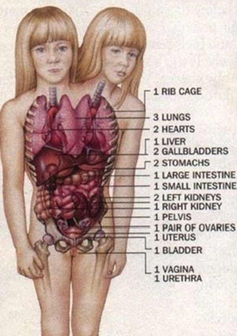 Their Internal Organs Are A Un... is listed (or ranked) 2 on the list 15 Things Most People Don't Know About Conjoined Twins Abby And Brittany Human Oddities, Conjoined Twins, Internal Organs, Medical Anatomy, Large Intestine, Summer Wedding Outfit Guest, Body Anatomy, The Human Body, Human Anatomy