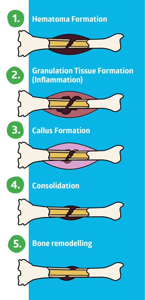 Bone Healing Process, Metatarsal Fracture, Musculoskeletal Disorders, Heal Broken Bones, Fracture Healing, Forensic Anthropologist, Bone Healing, Hip Fracture, Nursing Cheat