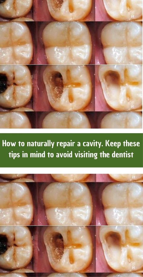 It’s important to clarify that while a healthy diet and good oral hygiene can help prevent cavities and may aid in the remineralization of teeth in very early stages, once a cavity has formed, it cannot be completely “repaired” naturally at home. Cavities are permanent damage to the tooth enamel that typically require dental intervention to treat. The information provided here aims to offer guidance on how to support oral health and potentially slow the progression of early tooth decay, but it should not replace professional dental advice and treatment. Natural Cavity Repair, Cavity Remedy, Mineral Rich Foods, Remineralize Teeth, Tooth Cavity, Tooth Decay Remedies, Heal Cavities, Tooth Enamel, Teeth Health