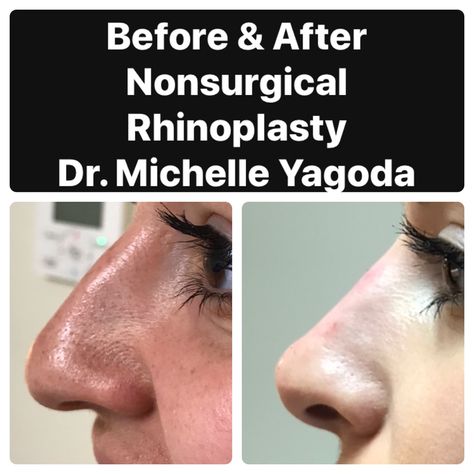 Liquid Nose Job Before And After, Ideal Nose Rhinoplasty, Liquid Rhinoplasty Before And After, Rhinoplasty Before After, Nose Inspiration, Liquid Nose Job, Liquid Rhinoplasty, Nose Rhinoplasty, Nose Lift