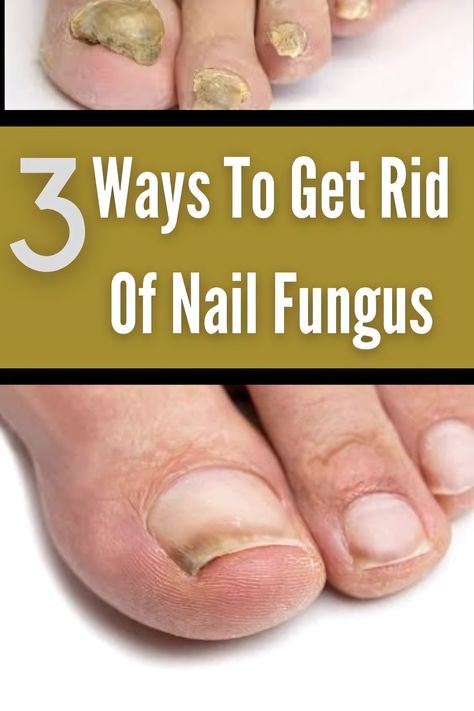 Fungal Nail Infections How To Get Rid Of Toenail Fungus, Toe Fungus Remedy, Nail Remedies, Natural Antifungal, Fingernail Fungus, Toenail Fungus Remedies, Nail Problems, Nail Fungus Remedy, Nail Infection