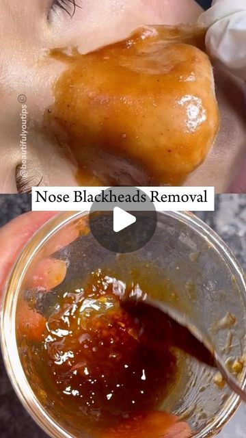 Best Mask For Blackheads, Diy Facemask Skincare Blackheads, Face Mask That Pulls Out Blackheads, How To Make Face Mask For Blackheads, Diy White Head Remover, Getting Rid Of Blackheads On Nose, Blackheads Mask Diy, Face Pack For Blackheads, What Helps Get Rid Of Blackheads