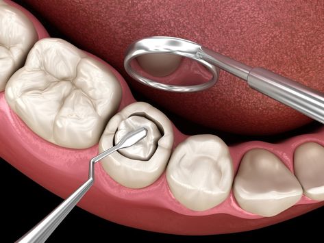 The term ‘plastic’ in periodontal plastic surgery has been derived from the Greek word, ‘plastic’. In Greek, it refers to modeling or sculpting. It is a sub-field of dentistry that specializes in correcting or restoring the function and form of teeth. Composite Fillings, Cavity Filling, Tooth Filling, Dental Decay, Tooth Cavity, Molar Tooth, Dental Fillings, Dental Cavities, Diy Teething