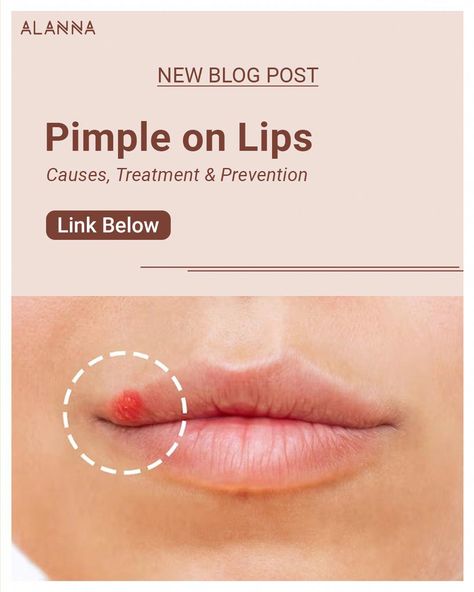 Pimples Around Lips, Pimples On Lip Line, How To Treat Pimples, Blister On Lip, What Causes Pimples, Lip Pimple, Zit Remedy, Inflamed Pimple, Redness Pimple