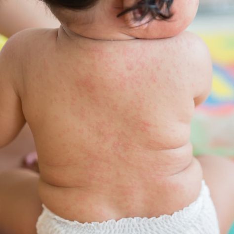 Roseola: How to Soothe ‘Sixth Disease’ Symptoms by @draxe Viral Rash, Toddler Rash, Types Of Rashes, Writing Portfolio, Vitamin C And Zinc, Sick Baby, Disease Symptoms, Asthma Symptoms, Viral Infection