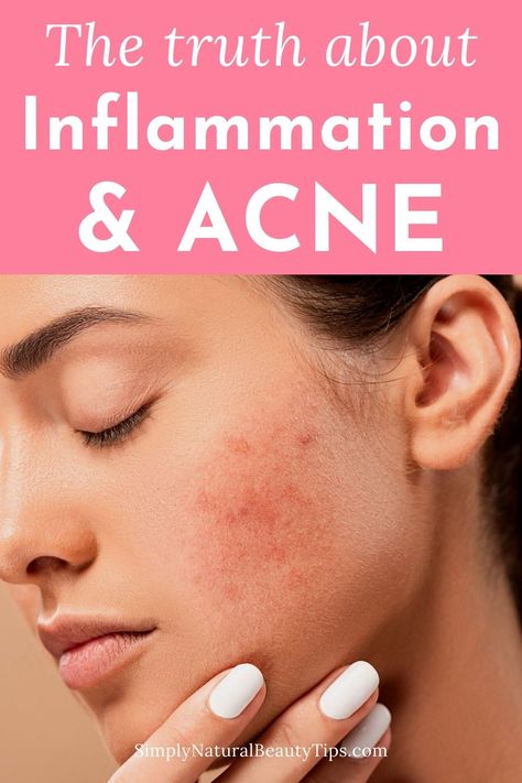 Face Inflammation Remedies, How To Heal Acne, Skin Inflammation Remedies, Skin Detox Acne, Orange Detox Water, Clear Acne Naturally, Acne Diet Plan, Acne Detox, Simple Drinks