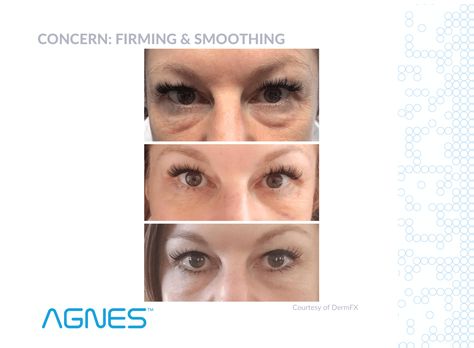 AGNES RF - Fat Removal that tightens smooths and sculpts - Saving Face, Nasolabial Folds, Medical Art, Fat Removal, Dermal Fillers, Tattoo Removal, Medical