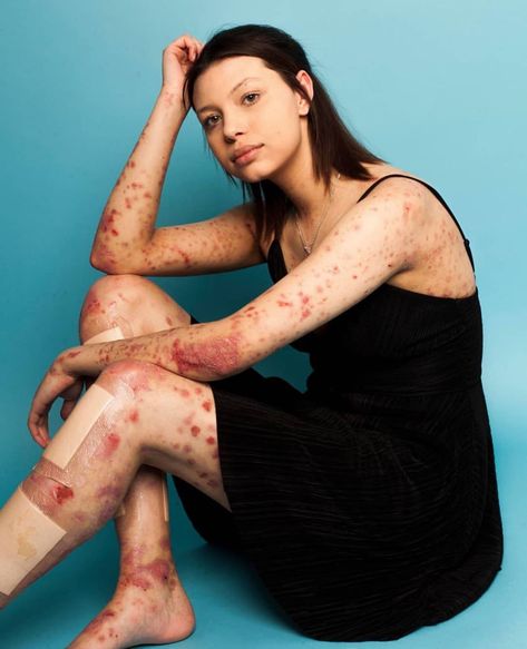 Epidermolysis Bullosa, Body Positive Fashion, Unsolicited Advice, Grace Beauty, Skin Imperfection, Growing Old, Body Positivity, Fashion Beauty, Conditioner