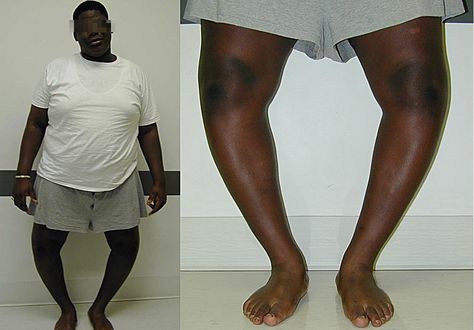 Orthopedic complication of obesity - Blount disease. Marked obesity and bilateral genu varum is present. Genu Varum, Ortho Nurse, Bow Legged Correction, Medical Images, Best Workout Plan, Bow Legged, Lycra Men, Trigger Point, Orthopedic Surgery