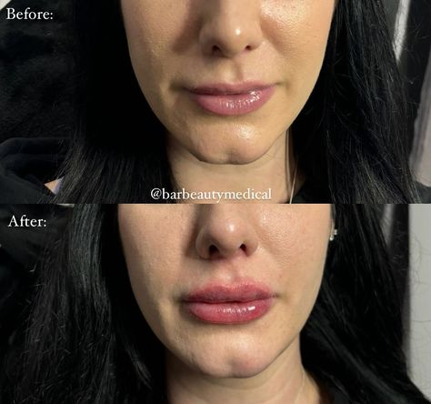 Gorgeous lip filler done by @cosmeticnurse.noor 💋 Our client was concerned with the size of her lips in proportion to her other facial features. Nurse Noor subtlety enhanced her lips and we’re obsessed with the results✨ *bruising subsides after a few days* #lipfiller #filler #torontolipfiller #torontobotox #botox #medspa #torontomedspa Lip Filler, Lip Fillers, Med Spa, Facial Features, Facial, Lips, Quick Saves