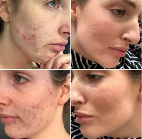 Have you seen the result of using Nu Skin Ageloc Lumispa? It helps to deep cleanse the skin, keeping the pores healthy and skin gradually better and glowing! Check it out from our store! Lumispa Nuskin, Skin Care Benefits, Reverse Aging, Medical Grade Silicone, Acne Solutions, Acne Free, Remove Acne, Skin Products, Skin Care Acne