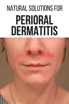 PERIORAL DERMATITIS: YOUR ULTIMATE GUIDE TO LONG-TERM HEALING Facial Rash Remedies, Redness Around Mouth, Exema Treatments For Face, Dry Patchy Skin On Face, Dry Red Patches On Face, Dry Bumpy Skin Face, Face Itching Remedies, Dry Red Skin On Face Remedies, Dry Red Skin On Face