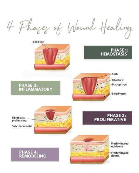 4 Stages of Wound Healing | physical therapy Stages Of Wound Healing, Wound Healing Stages, Wound Healing Nursing, Ostomy Nursing, Wound Nurse, Natural Wound Care, Wound Care Nurse, Rectus Abdominis Muscle, Wound Care Nursing