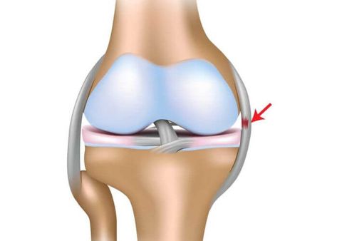 key MCL tear symptoms and learn how to identify and address them effectively. Your guide to understanding MCL tear symptoms for prompt care. - #DescribingMCLtearsymptoms #ExplainMCLtearwarningsignals #HowtorecognizesymptomsofMCLtear? #IndicatorsofMCLrupture #Innerkneeligamenttearsigns #Kneejointtearmanifestations #Kneeligamenttearsymptoms #MCLdamagesymptoms #MCLruptureindicators... Knee Strength, Knee Ligaments, Ligament Tear, Warm Up Routine, Body Ache, Knee Injury, Wellness Tips, Natural Remedies, Health Tips