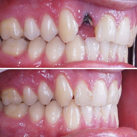 Even with good dental health, many can still experience tooth loss. Tooth loss can have negative effects later in life on the remaining teeth such as shifting, TMJ dysfunction, and periodontal conditions. With several options for replacing missing teeth, like dental implants, why gamble with not replacing missing teeth? Here’s a before and after photo of a dental implant case handled at @AestheticSmileReconstruction. #Missingtooth #Tooth #DentalImplants #cosmeticimplants #brokentooth Dental Before And After, Dental Implants Before And After, Dental Animation, Aesthetic Smile, Call Logo, Medical Animation, Liver Diet, Loose Tooth, Tooth Replacement