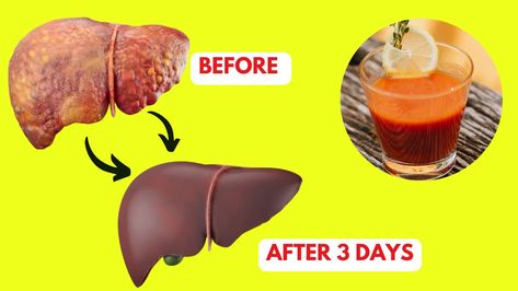 How to Liver Detox and Cleanse, Recipe, Home Remedies, Natural Remedies to avoid Fatty Liver Liver Detox Cleanse From Alcohol, Liver Cleanse Home Remedies, Liver Cleanse Juice, Lung Detox, Liver Recipes, Cleanse Your Liver, Liver Detoxification, Liver Detox, Detox Cleanse