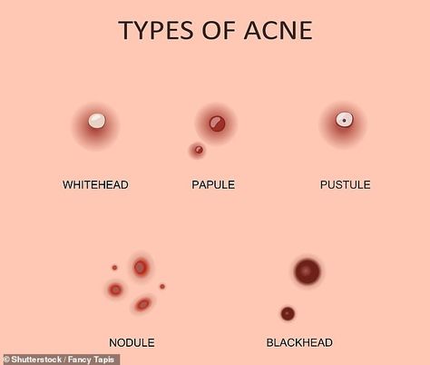 3 step routine for blackheads Chin Acne, Blind Pimple, Pimples Under The Skin, Esthetician Room, Face Care Routine, Types Of Acne, Hormonal Acne, Cystic Acne, Effective Skin Care Products