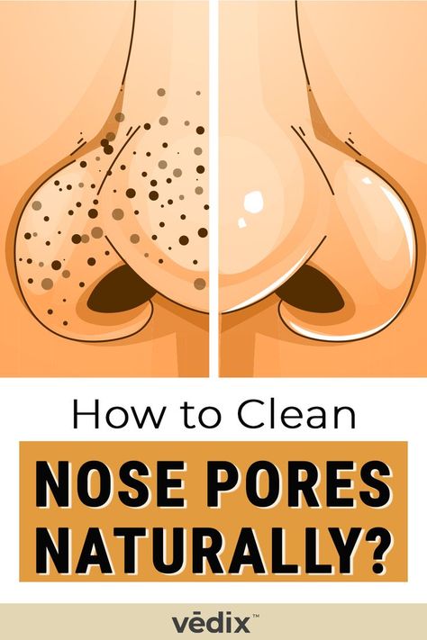 nose pores Clean Nose Pores, Blind Pimple, Pimples Under The Skin, Nose Pores, Blackheads On Nose, Prevent Pimples, How To Get Rid Of Pimples, Natural Sleep Remedies, Get Rid Of Blackheads