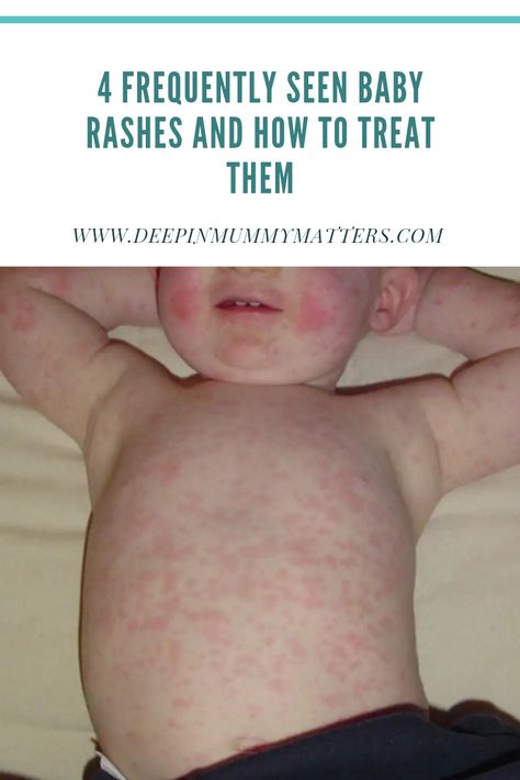 4 Frequently Seen Baby Rashes and How to Treat Them 2 Heat Rash Remedy For Babies, Baby Heat Rash, Heat Rash Remedy, Teething Rash, Viral Rash, Baby Rashes, Home Remedies For Rashes, Rash Remedies, Baby Skin Rash