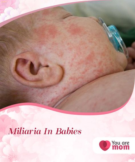 Miliaria In Babies   Miliaria in babies, also known as sudamina, is more common than you can #imagine. It is a skin rash that occurs in babies due to their #delicate #skin.  #Health Newborn Rash On Face, Heat Rash Remedy For Babies, Heat Rash On Face, Face Rash Remedies, Newborn Rash, Baby Rash On Face, Baby Heat Rash, Skin Rash On Face, Heat Rash Remedy