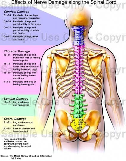 Effects of Nerve Damage Along the Spinal Chord ~ Infographic Spinal Nerves Anatomy, Nerve Anatomy, Spinal Nerve, Spine Health, Muscle Anatomy, Sciatic Nerve Pain, Human Anatomy And Physiology, Medical Anatomy, Nerve Damage