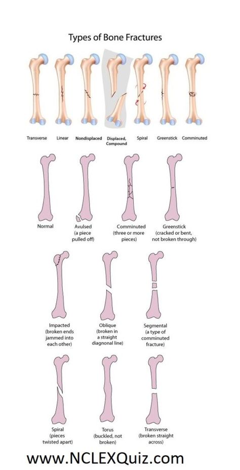 Future Surgeon, Surgical Technologist Student, Types Of Fractures, Types Of Bones, Radiology Student, Nurse Study, Radiology Technician, Bells Palsy, Medical Words