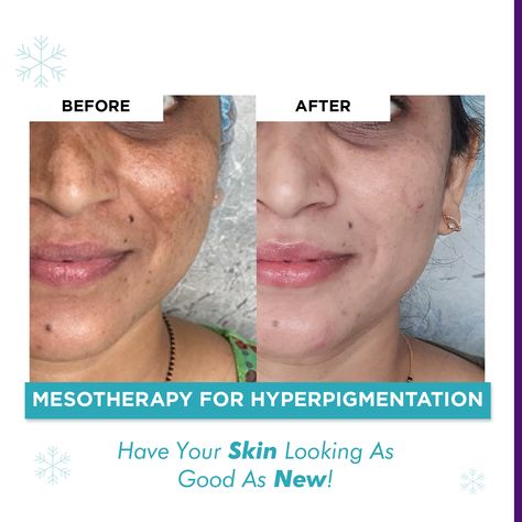 Mesotherapy Before And After, Mesotherapy Face, White Eyeliner Looks, Green Eyeshadow Look, Good Morning Coffee Images, Alt Makeup, White Eyeliner, Simple Makeup Looks, Coffee Images