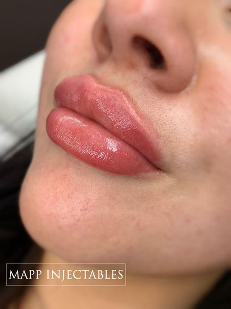 Plump lip filler Lip Filler Russian Lips, Types Of Lip Filler Shapes, Lip Fillers Before And After 1ml Russian, Russian Lips Filler 1ml, 1 Ml Lip Filler, 1ml Lip Filler, Lip Goals, Russian Lips, Filler Lip