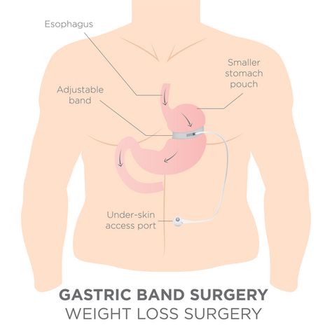 The prevalence of obesity in the United States is rising due to several factors that promote weight gain. Weight loss methods work for some and not others. When all else has failed, you may qualify for bariatric surgery, including gastric band surgery. Gastric banding, often known as lap-band surgery, is one of the surgical therapies for obesity. In this article, we will be looking at the basics of gastric banding and gastric band side effects. #GastricBand #BariatricSurgerySideEffects Lap Band, Gastric Band, Bariatric Surgeon, Neck Exercises, Patient Experience, Abdominal Pain, Gain Weight, Side Effects, Weight Gain