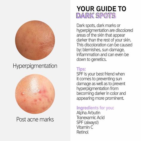 Asian Skin Care Routine, Post Inflammatory Hyperpigmentation, Post Acne Marks, Skin Advice, Skin Aesthetics, Diy Acne, Acne Skincare Routine, Acne Scar, Dermatological Skin Care