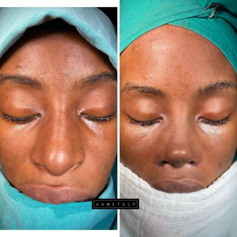 Nose Job Black Women, Bulbous Nose Rhinoplasty Before After, Perfect Nose Front View, Wide Nose Rhinoplasty, Ethnic Nose Job, Nose Goals, Closed Rhinoplasty, Books Summary, Facial Balancing