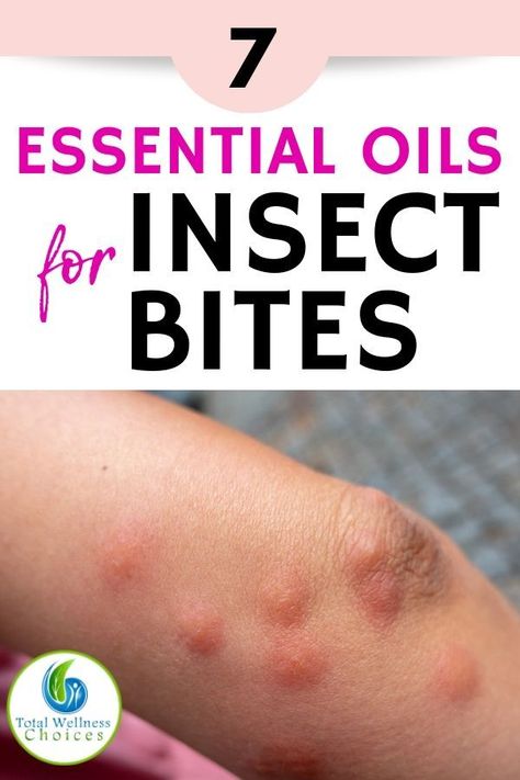 Essential Oils for Insect Bites Relief! Oils For Mosquito Bites Itch, Bug Bites Relief, Essential Oils For Bug Bites, Oils For Bug Bites, Essential Oils Bug Bites, Essential Oils For Mosquitoes, Remedies For Mosquito Bites, Bug Bites Remedies, Bug Bite Relief