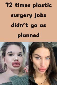 Celebrity Surgery, Cheek Implants, Warrior Tattoo Sleeve, Plastic Surgery Fail, Plastic Surgery Gone Wrong, Body Makeover, Celebrity Plastic Surgery, Celebrities Before And After, Fashion Fail