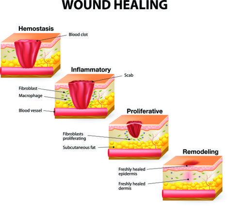 How Wounds Heal: The 4 Main Phases of Wound Healing | Shield HealthCare Healing Illustration, Stages Of Healing, Wound Care Nursing, Integumentary System, Nursing School Notes, Nursing Tips, White Blood Cells, Wound Care, Body Healing