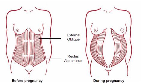 Diastasis Recti Workout, Pregnant Tips, Healing Diastasis Recti, Diary Of A Fit Mommy, Post Baby Workout, Diastasis Recti Exercises, Body After Baby, Mommy Tummy, Post Pregnancy Workout