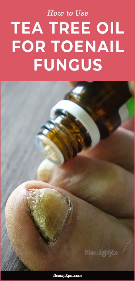 The 10 Best Home Remedies for Toenail Fungus Nail Fungal Infection Toenails, Toe Nail Fungal Infection, Medical Remedies, Toenail Fungal Infection, Tea Tree Oil Uses, Nail Remedies, Natural Antifungal, Toenail Fungus Remedies, Nail Fungus Remedy