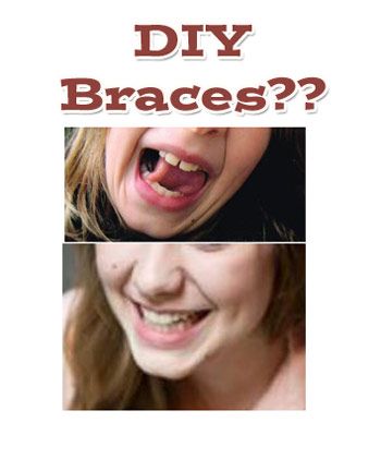 DIY Braces when you can't afford Dental Care Straighten Teeth At Home Diy, Diy Braces For Teeth, Teeth Straightening At Home, Straight Teeth Without Braces, Fix Overbite, Straighten Teeth Without Braces, Teeth After Braces, Cheap Gardening, Diy Braces