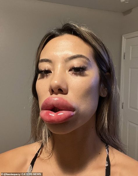 Basia Query, 24, from Las Vegas, Nevada, saw her lips swell to three times their normal size leaving her fearing they would be cut off after she had an allergic reaction to fillers Overfilled Lips, Hyaluronic Pen, Last Vegas, Botox Lips, Fake Lips, Anaphylactic Shock, Itchy Throat, Lip Filler, Duck Face